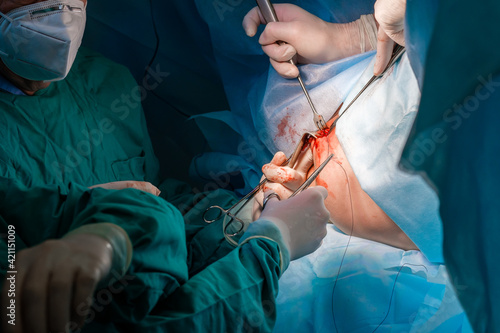 Surgeons use medical instruments to suture human skin during proctological minimally invasive surgery on the anus. Close-up of hands in sterile gloves, covered with blood. Blue uniform and masks.