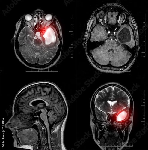 Magnetic resonance imaging of a patient with a temporal horn cyst of the left lateral ventricle of the brain. Atrophic changes in the temporal lobe. Causes of headaches. Arachnoid cyst