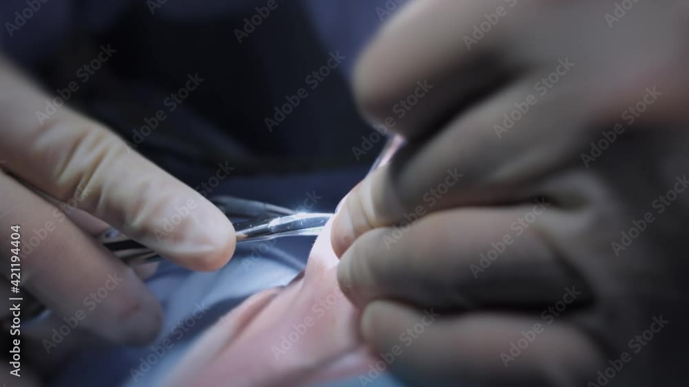 Surgeon's hands while performing plastic surgery on nose Surgeon's hands while performing plastic surgery on nose