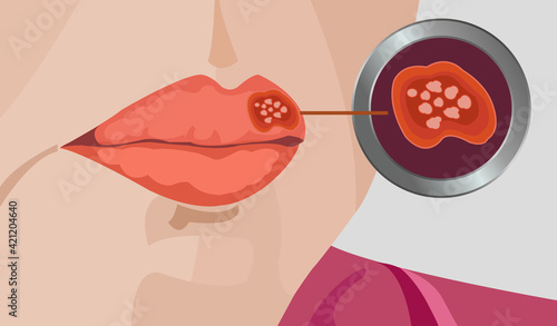 Herpes simplex virus on lip close up illustration