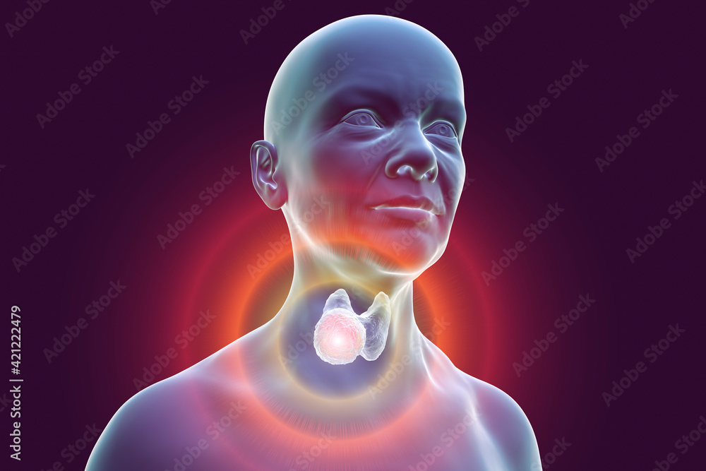 Thyroid cancer in women, illustration showing tumor inside thyroid gland Stock Illustration