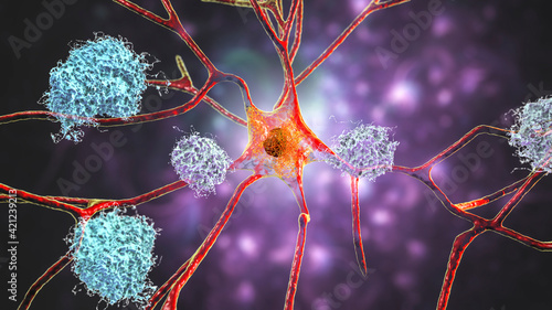 Neurons in Alzheimer's disease. Illustration showing amyloid plaques in brain tissue photo