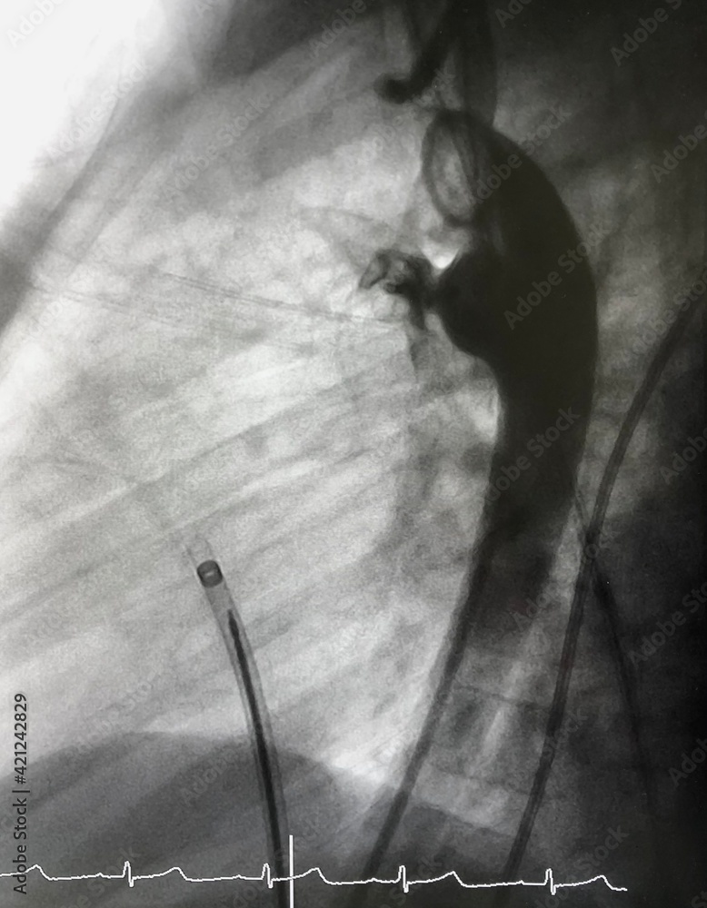 Aortography showed patent ductus arteriosus (PDA) during PDA closure