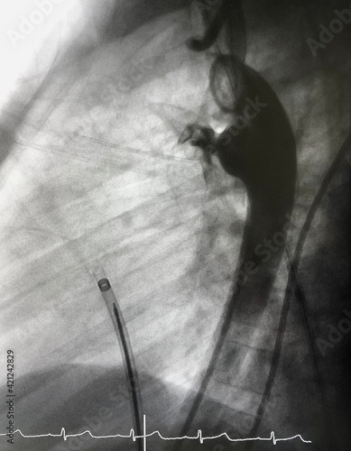 Aortography showed patent ductus arteriosus (PDA) during PDA closure device via endovascular procedure. photo