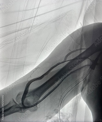 Fotografie Angiogram of hemodialysis arteriovenous fistula (AVF) during Endovascular intervention in end stage renal disease (ESRD) patient