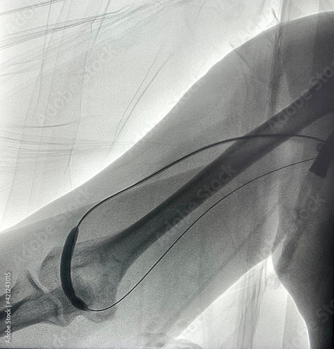 Angiogram shown balloon inflated in hemodialysis arteriovenous fistula (AVF) during Endovascular intervention. photo