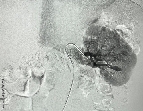 Tableau sur toile Angiogram shown renal artery rupture with bleeding around lesion