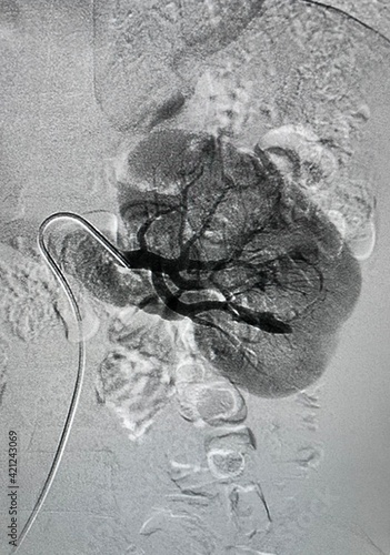 Foto Angiogram shown renal artery rupture with bleeding around lesion