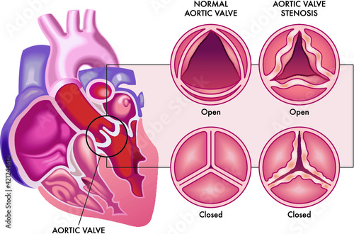 Medical illustration shows the difference between a normal aortic valve and one with stenosis, open and closed, and its location in the heart, with annotations. photo