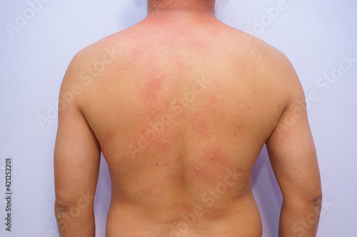 Man adult onset food allergy have had a severe reaction emergency care confirmed diagnosis Itchy rash, suffocate, faint and feverish With symptoms on legs, arms, torso, abdomen, back, face, neck body.
