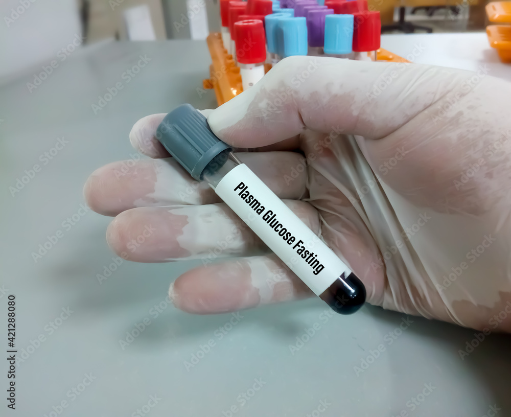 Technician or scientist hold a sample tube of Plasma glucose Fasting (FGP) test. Fasting blood sugar(FBS) for diagnosis hyperglycemia or hypoglycemia in Diabetes Mellitus (DM).Medical testing concept Technician or scientist hold a sample tube of Plasma glucose Fasting (FGP) test. Fasting blood sugar(FBS) for diagnosis hyperglycemia or hypoglycemia in Diabetes Mellitus (DM).Medical testing concept