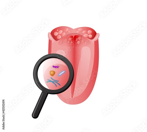 Tongue examination infection and bacteria illustration. Magnifying glass study inflammation red tissue and taste disturbances caused by harmful vector parasites.
