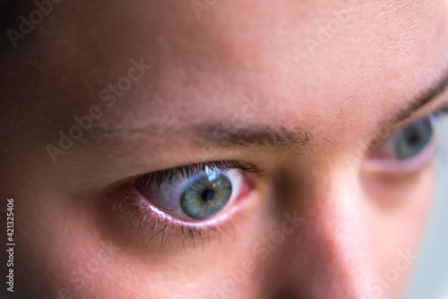 Macro closeup profile portrait of young woman face with Grave's disease hyperthyroidism symptoms of ophthalmopathy bulging eyes and proptosis edema photo