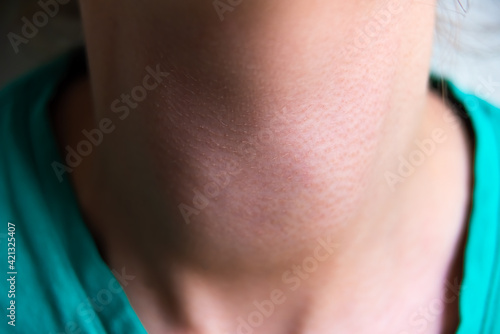 Macro closeup of young woman neck with Grave's disease hyperthyroidism symptoms of enlarged thyroid gland goiter