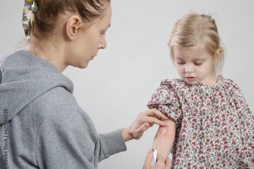 Mother applaying ointment onto red and itchy eczema on her daughter's arm. Toddler girl suffering from atopic dermatitis. Mother applaying ointment onto red and itchy eczema on her daughter's arm. Toddler girl suffering from atopic dermatitis.
