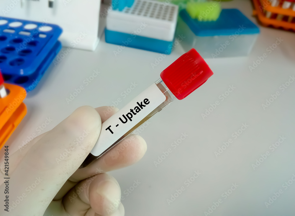 Blood sample in test tubes for hormonal examination of thyroid gland in laboratory. TUptake