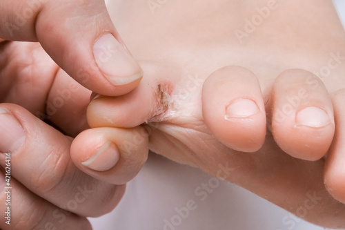 A woman examines her foot with fungus or eczema between toes
