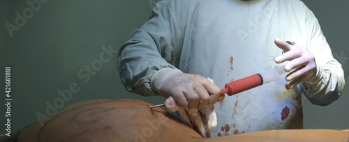 Bild auf Leinwand Lipotransferencia