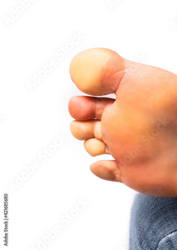 Female foot with Raynaud's syndrome, Raynaud's phenomenon or Raynaud's  diseases. Some toes turned white (pallor) from lack of blood flow. Other toes are dark red and blueish. Selective focus. photo