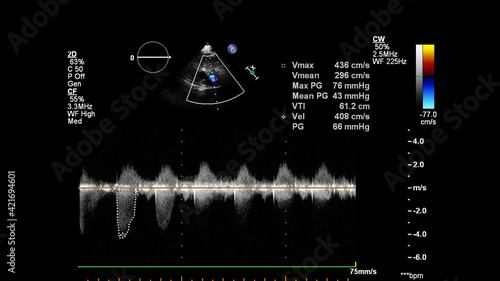 Image of the heart during transesophageal ultrasound with Doppler mode.