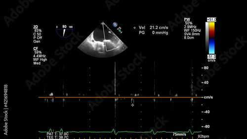 Image of the heart during transesophageal ultrasound with Doppler mode.