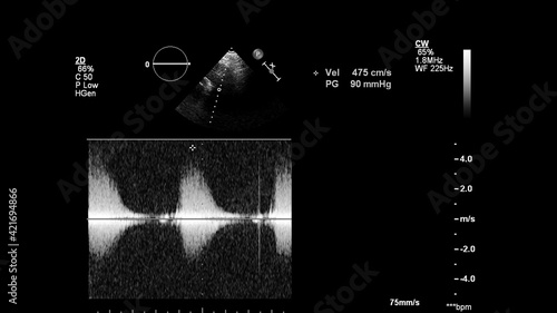 Image of the heart in gray-scale mode during transesophageal ultrasound.