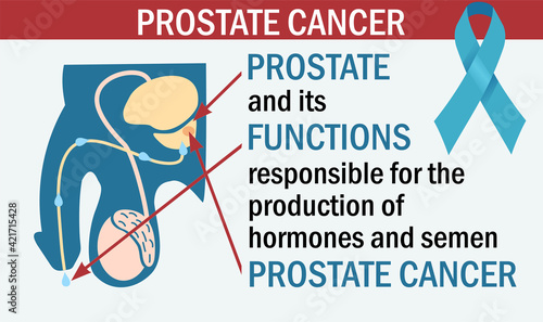 Diagram of prostate cancer illustration. Prostatitis. Benign prostatic hyperplasia. infographics in color style. Medical Infographic set elements and symbols for design.