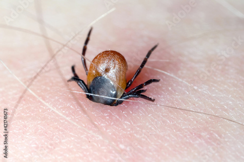 Tick with its chelicerae sticking in human skin.