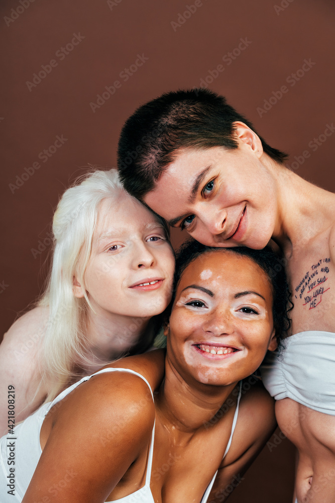 Group of multiethnic women with different kind of skin posing together in studio. Concept about body positivity and self acceptance Group of multiethnic women with different kind of skin posing together in studio. Concept about body positivity and self acceptance