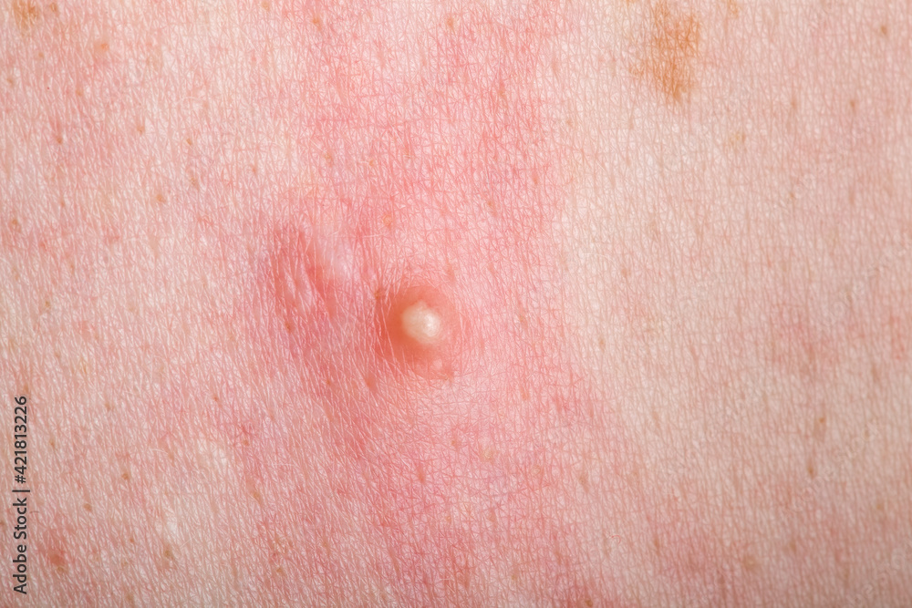 Fototapeta premium ripe pimple on the inflamed reddened skin of a person close-up, problem dry skin with an inflammatory rash.