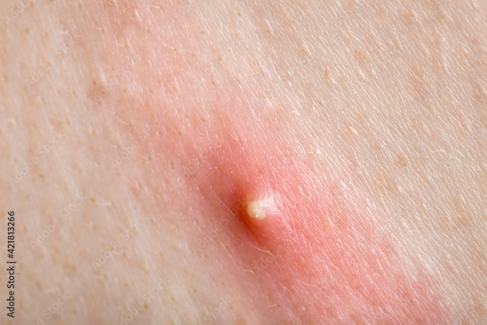 Fototapeta premium purulent pimple on inflamed human skin close-up, teen body health and problems.