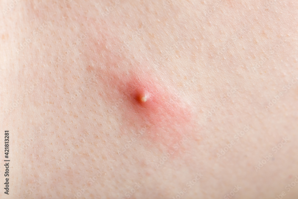 inflamed purulent pimple with pus on human body skin close-up, health care dermatology.
