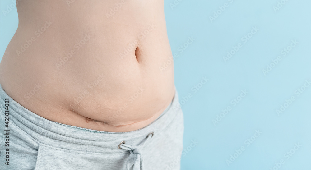 Naklejka premium Closeup of woman belly with a scar from a cesarean section on blue background.