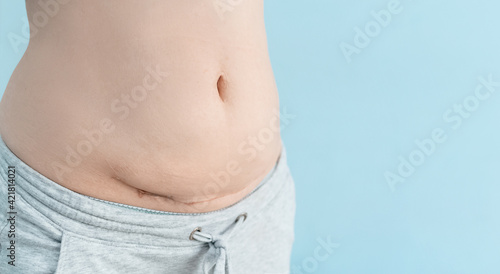 Closeup of woman belly with a scar from a cesarean section on blue background. photo