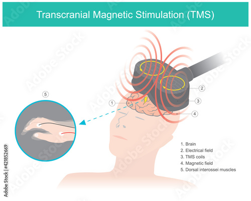 Transcranial Magnetic Stimulation (TMS). The brain stimulation in which a changing magnetic field is used to cause electric current. Healthcare and medical illustration..