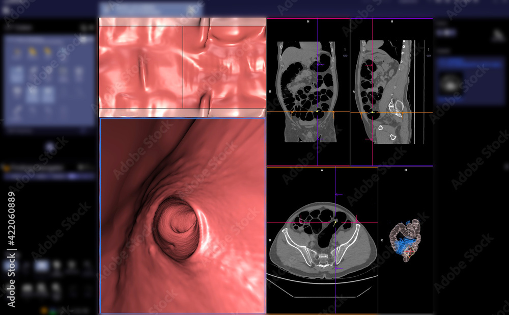 CT colonography or CT Scan of Colon axial view vs Coronal view and 3D  rendering image on the screen for diagnosis large bowel cancer. Photos |  Adobe Stock