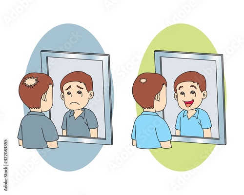 middle aged man with alopecia problem. before and after hair treatment and transplantation. hair loss concept. vector illustration isolated cartoon hand drawn
