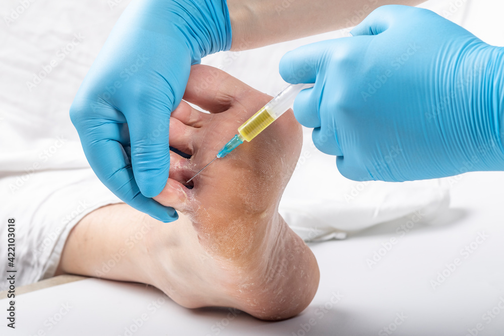 studio lighting. a human leg on a white background. A doctor in blue gloves examines the legs with a fungal infection of the leg. Close-up studio lighting. a human leg on a white background. A doctor in blue gloves examines the legs with a fungal infection of the leg. Close-up