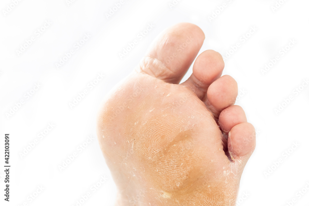studio lighting. a human leg on a white background. A doctor in blue gloves examines the legs with a fungal infection of the leg. Close-up studio lighting. a human leg on a white background. A doctor in blue gloves examines the legs with a fungal infection of the leg. Close-up