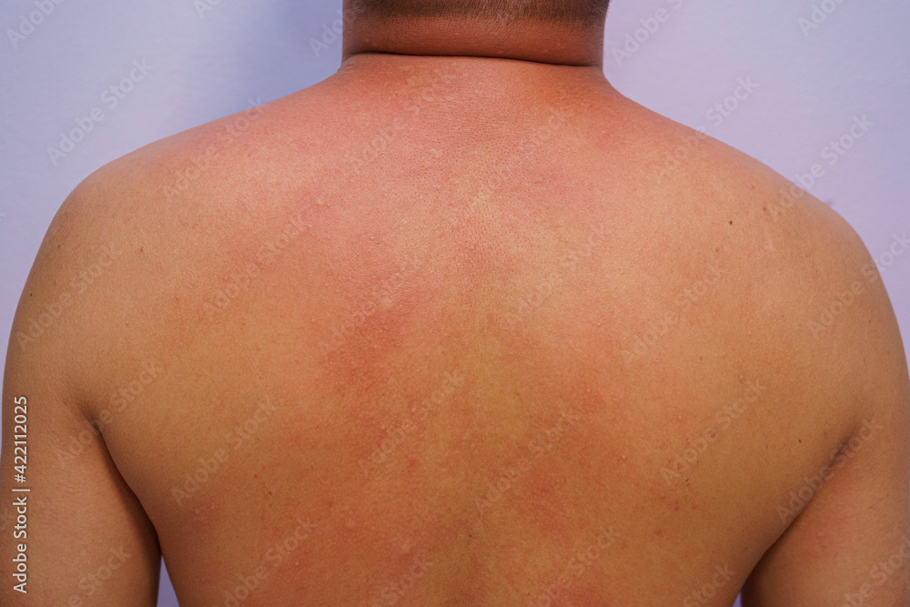 Man adult onset food allergy have had a severe reaction emergency care