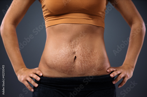 Foto Young mum standing with hands on hips and showing her belly full of stretch marks after pregnancy