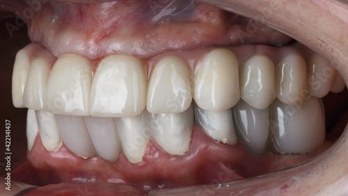 ceramic dental prosthesis in the oral cavity
