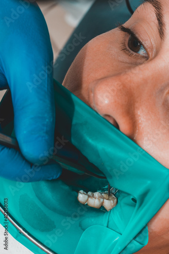 treatment of a chewing tooth, the dentist put a rubber dam, uses sterile tools, uses modern technology. photo