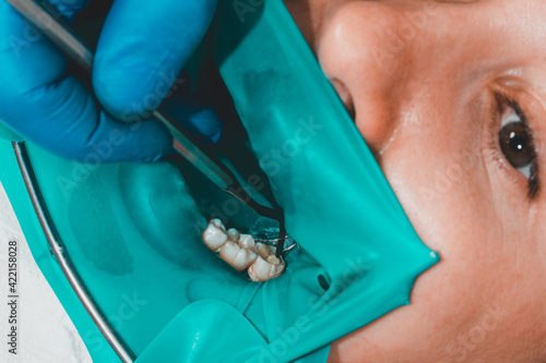 treatment of a chewing tooth, the dentist put a rubber dam, uses sterile tools, uses modern technology.