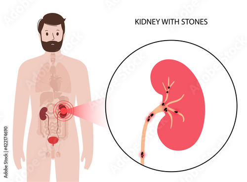 Kidney disease concept