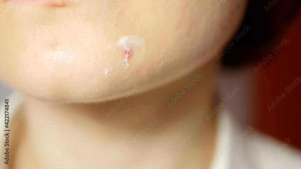 Close up woman applying anti acne cream. Dermatology cosmetics Close up woman applying anti acne cream. Dermatology cosmetics