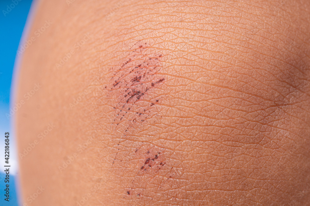 Fototapeta premium close up of little scab wound on kid's knee