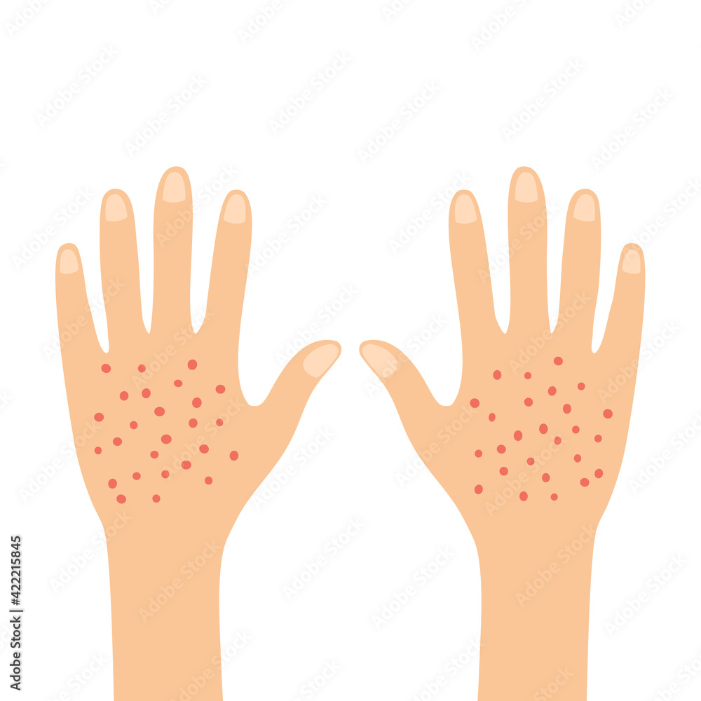 Red rash on back female hands skin in flat design on white background. Itching and irritation symptom. Red rash on back female hands skin in flat design on white background. Itching and irritation symptom.