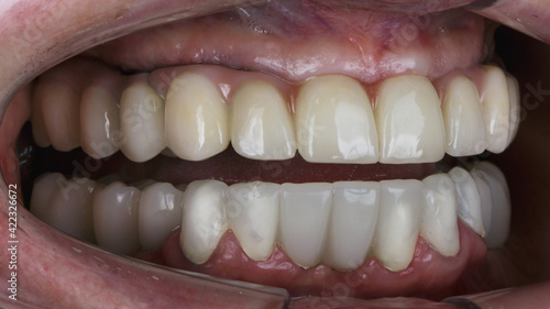 upper ceramic prosthesis in the oral cavity and crowns on the teeth