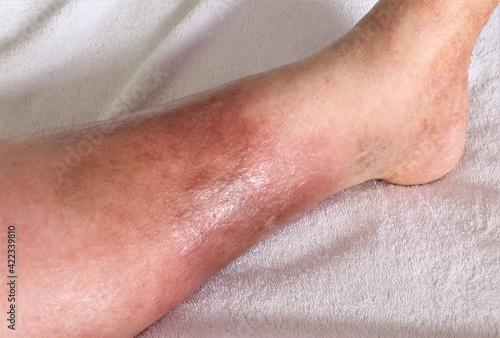 A woman's leg is shown, she is suffering from Chronic Venous Insufficiency with mild cellulitis in her legs. In bed as she rest to relieve heaviness, swelling, pain  redness in the leg. Top shot photo